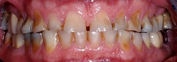 dents usées, dents courtes, dents abimées, usures dentaires