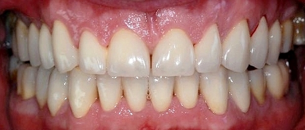 Facettes en céramique, dents blanches, couronnes dentaires