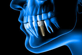 implant dentaire chirurgie