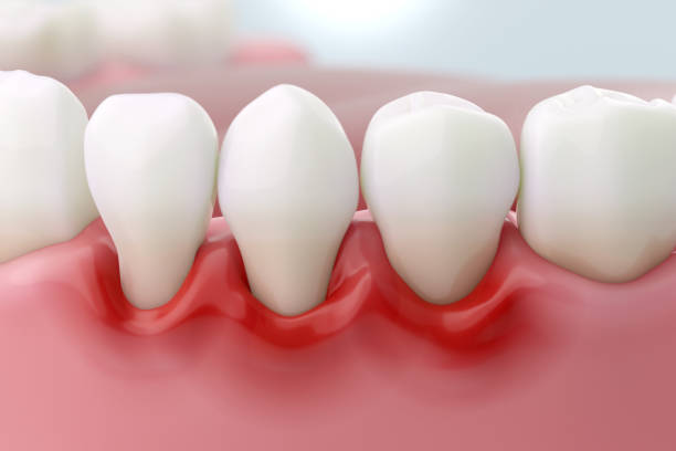 parondontite, gingivite, dechausement, saignement 