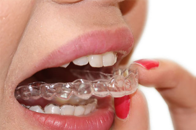 aligneur transparent, orthodontie invisible, invisalign, smilers
