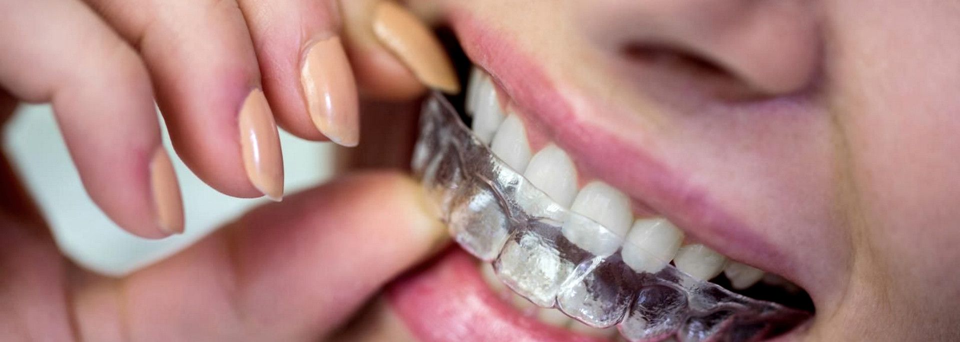 aligneurs transparents orthodontie Paris 17